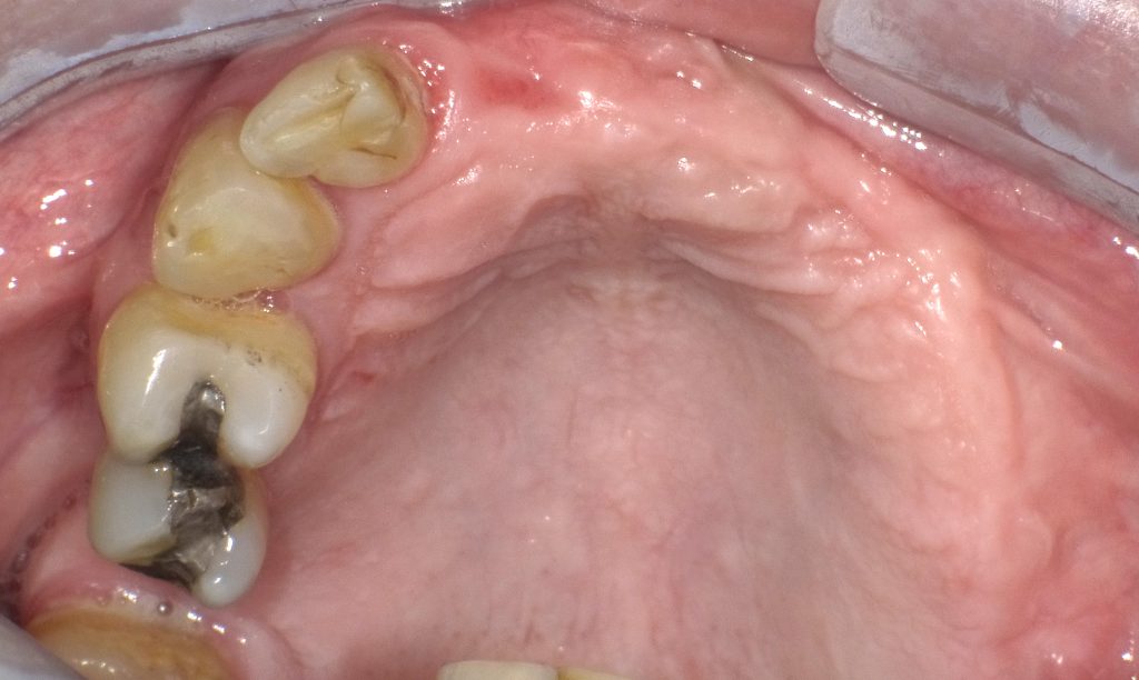 Knochenaufbau für Implantation - Misovic